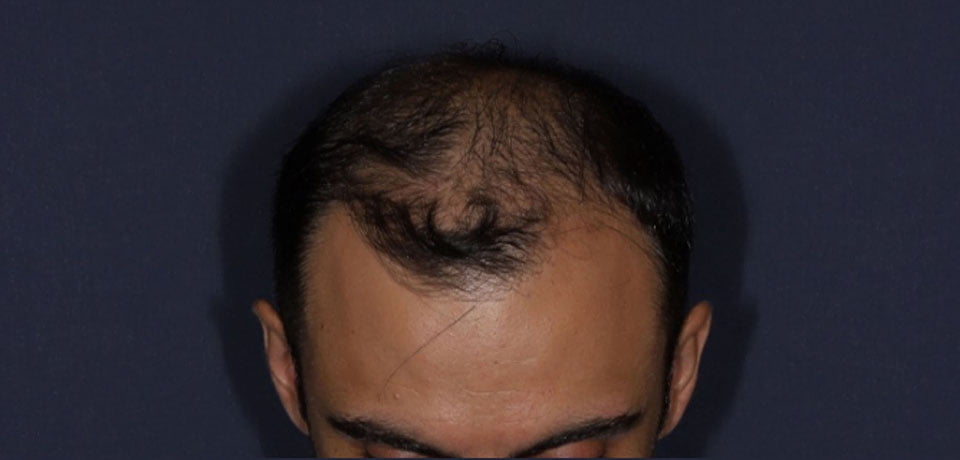 Before-Transplant păr